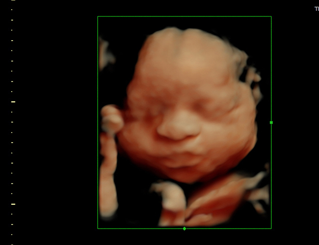 3D ultrasound image at 29 weeks